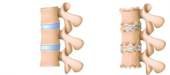 Kas yra osteochondrozė
