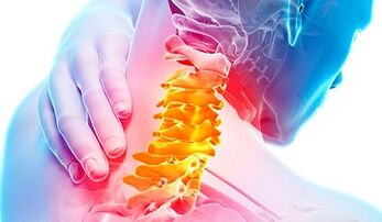 Gimdos kaklelio stuburo osteochondrozės požymiai