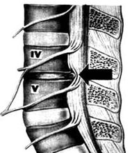 X -osteochondrozės juosmens departamento paveikslas