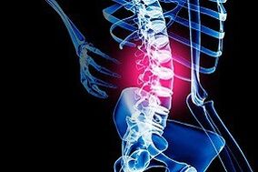 stuburo juosmeninės dalies osteochondrozė