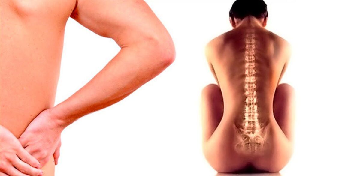apatinės nugaros dalies skausmas dėl osteochondrozės