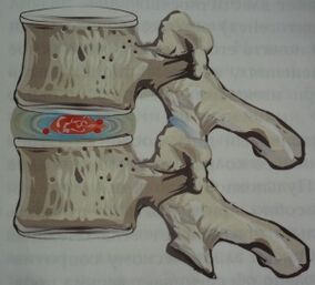 Pirmasis osteochondrozės etapas